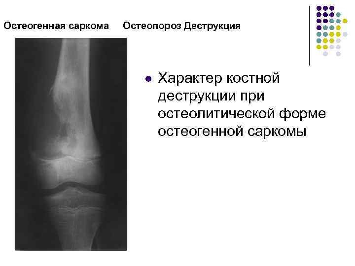 Остеогенная саркома Остеопороз Деструкция l Характер костной деструкции при остеолитической форме остеогенной саркомы 