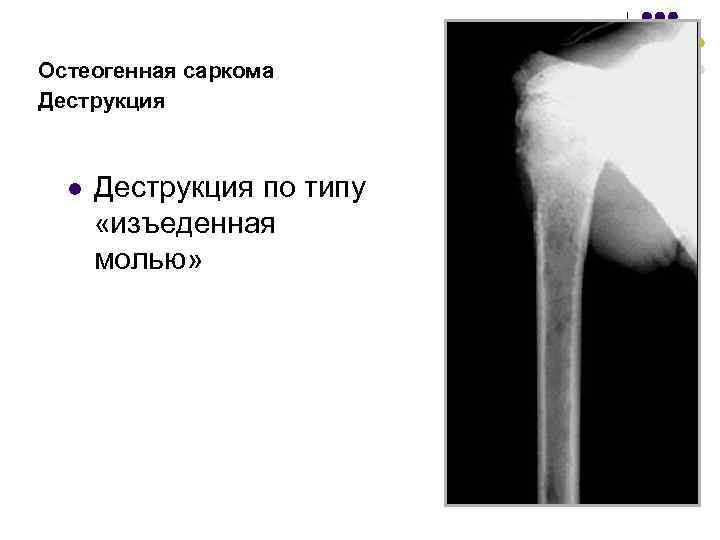 Чем отличается саркома. Остеогенная саркома бедренной кости рентген. Остеогенная саркома бедра кт.