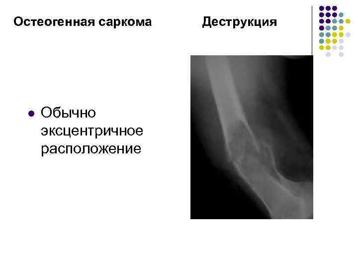 Остеогенная саркома l Обычно эксцентричное расположение Деструкция 