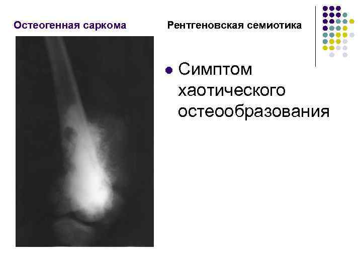 Остеогенная саркома. Рентгенологические симптомы остеогенной саркомы. Остеогенная саркома рентгенологические признаки. Типичная локализация остеогенной саркомы. Рентгенологические изменения при остеогенной саркоме.