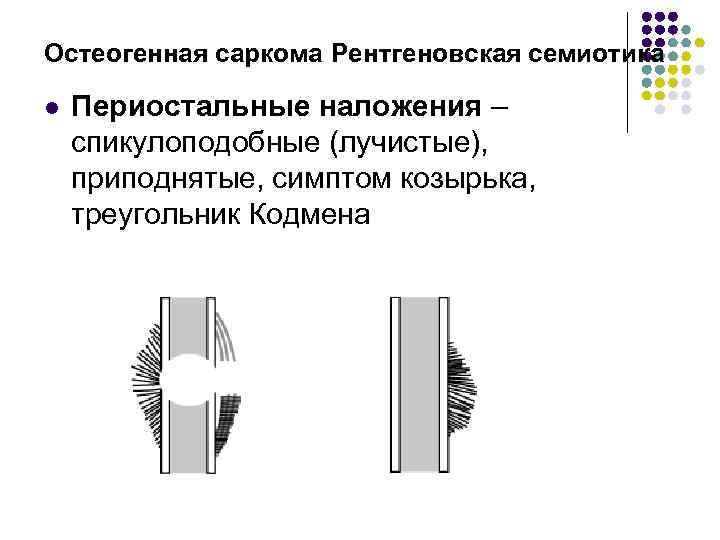 Остеогенная саркома Рентгеновская семиотика l Периостальные наложения – спикулоподобные (лучистые), приподнятые, симптом козырька, треугольник