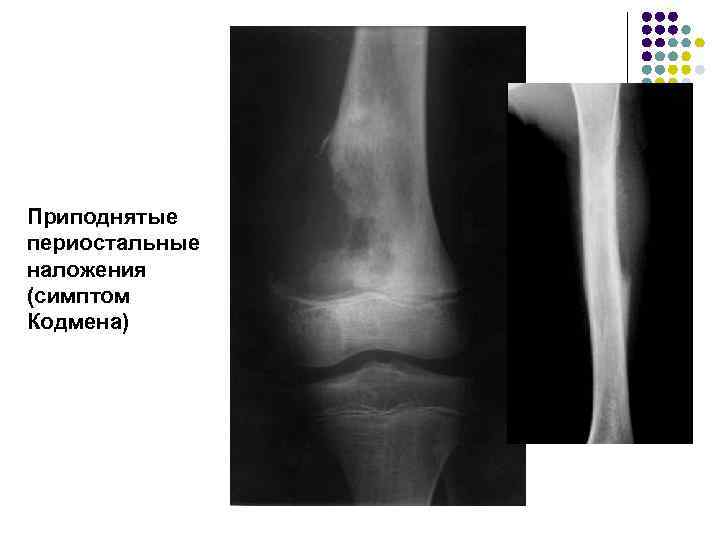 Приподнятые периостальные наложения (симптом Кодмена) 