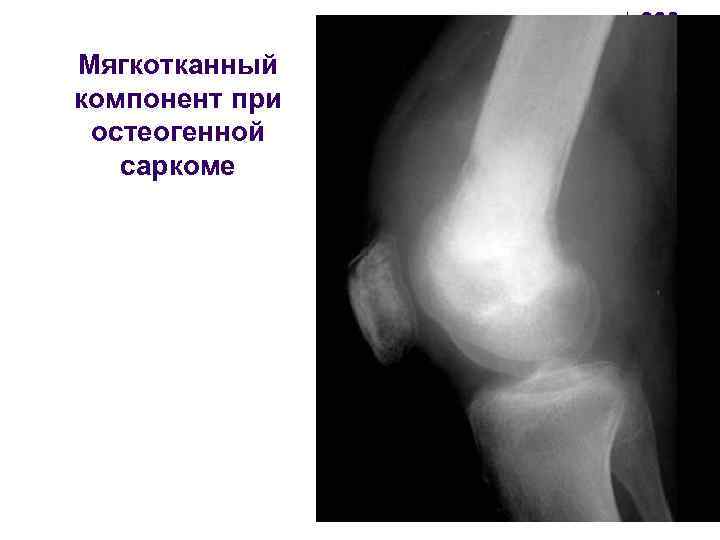 Мягкотканный компонент при остеогенной саркоме 