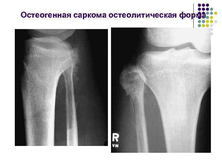 Остеогенная саркома остеолитическая форма 