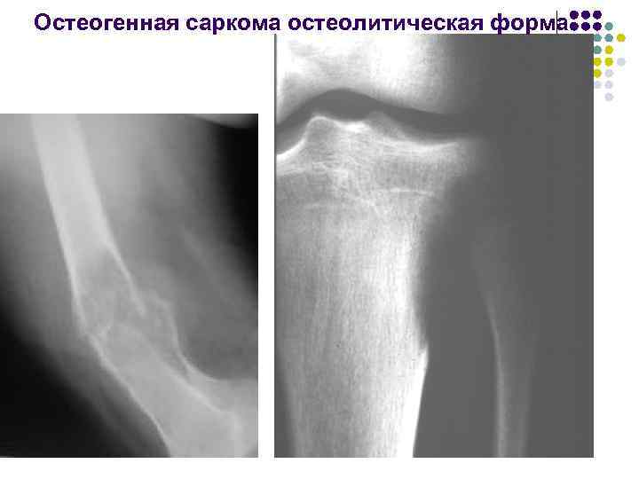 Остеогенная саркома. Остеогенная остеолитическая саркома. Остеолитическая саркома рентген. Остеогенная саркома остеобластическая форма. Остеолитическая остеогенная саркома рентген.