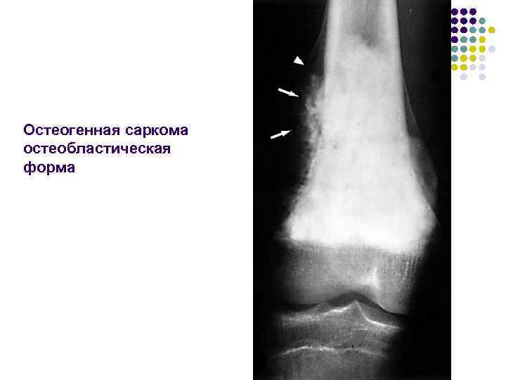 Остеогенная саркома остеобластическая форма 