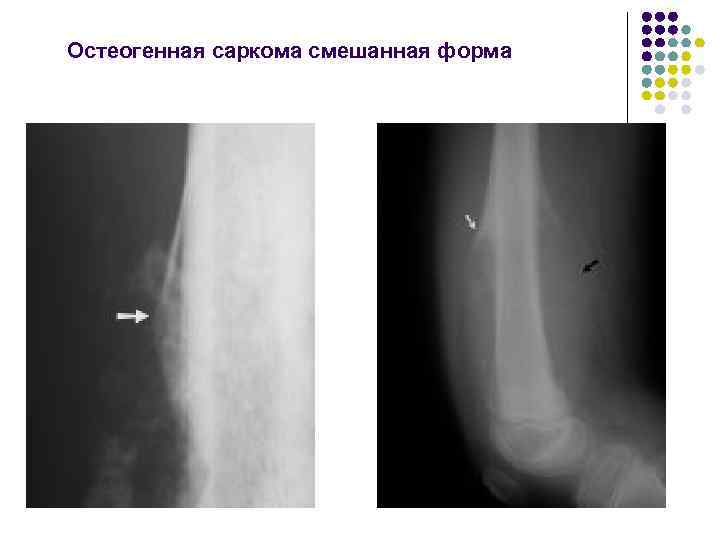 Остеогенная саркома смешанная форма 