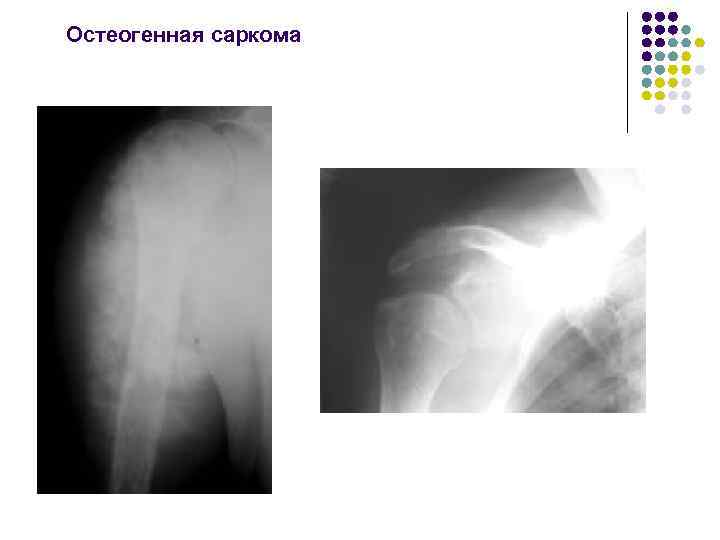 Остеогенная саркома 