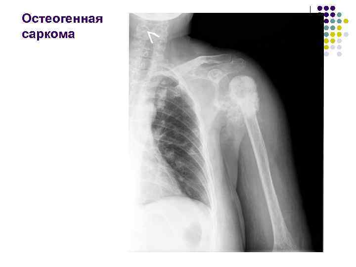 Остеогенная саркома 