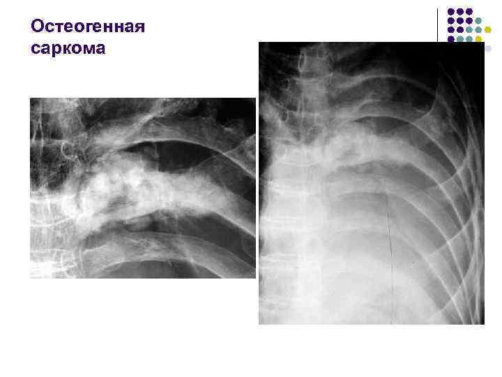 Остеогенная саркома 