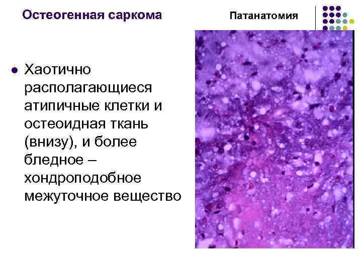 Остеогенная саркома l Хаотично располагающиеся атипичные клетки и остеоидная ткань (внизу), и более бледное