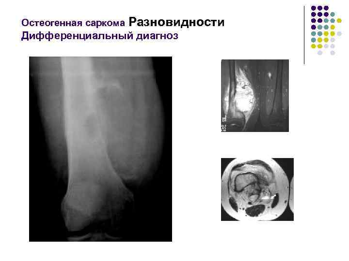 Остеогенная саркома Разновидности Дифференциальный диагноз 