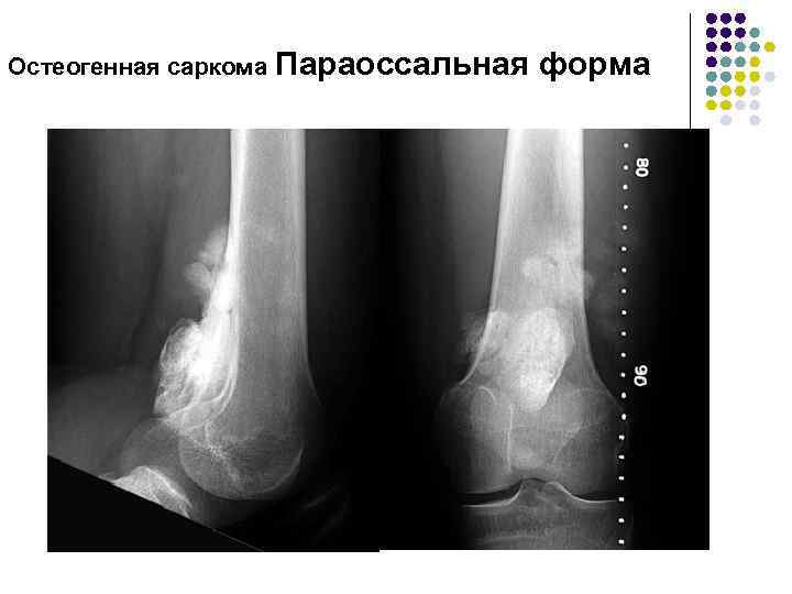 Остеогенная саркома Параоссальная форма 