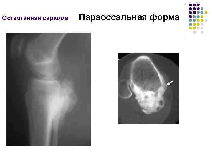 Остеогенная саркома Параоссальная форма 