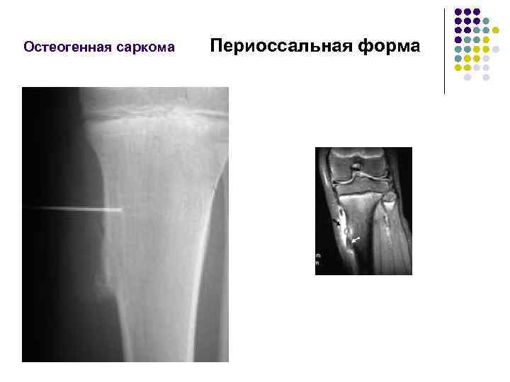 Остеогенная саркома Периоссальная форма 