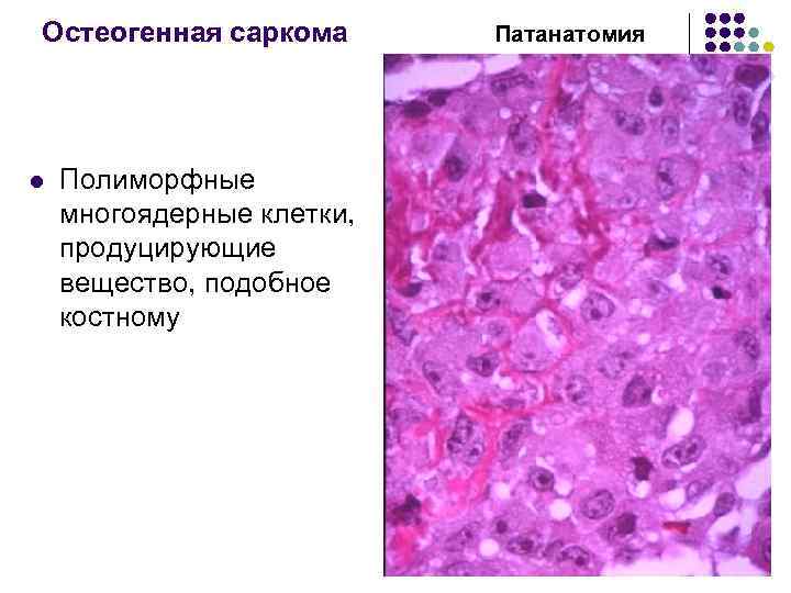 Остеогенная саркома l Полиморфные многоядерные клетки, продуцирующие вещество, подобное костному Патанатомия 