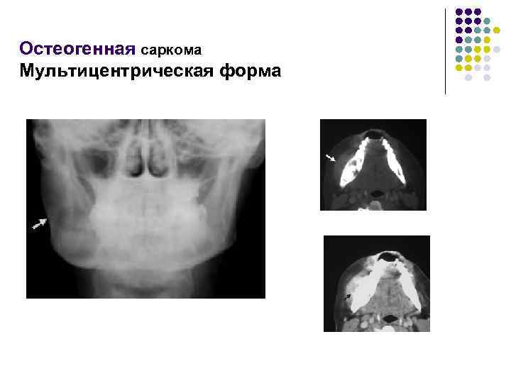 Остеогенная саркома Мультицентрическая форма 