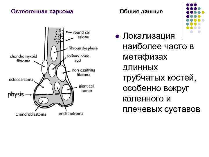 Опухоли костей схема