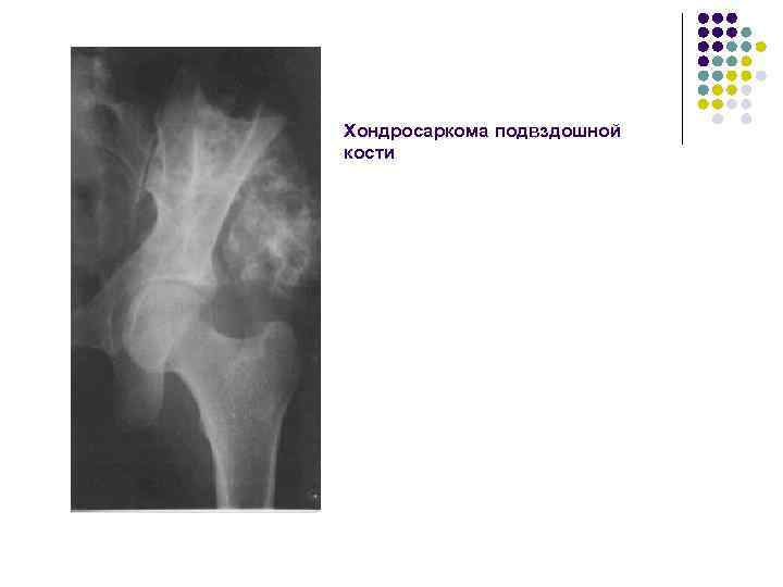 Хондросаркома подвздошной кости 