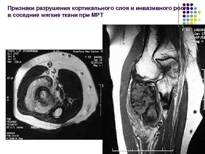 Признаки разрушения кортикального слоя и инвазивного роста в соседние мягкие ткани при МРТ 