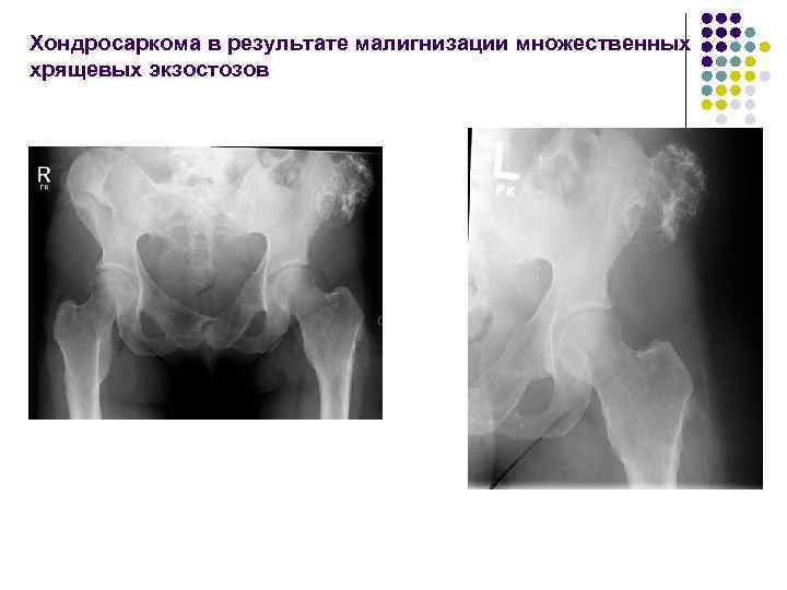 Хондросаркома в результате малигнизации множественных хрящевых экзостозов 