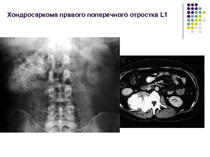 Хондросаркома правого поперечного отростка L 1 