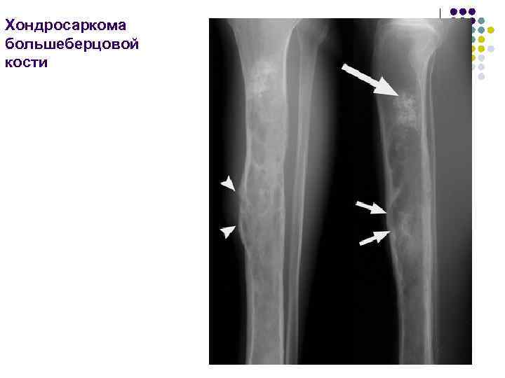 Хондросаркома большеберцовой кости 