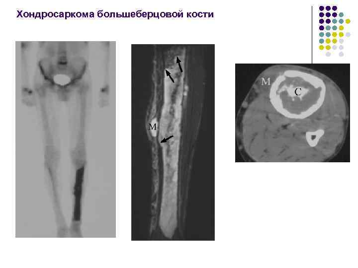 Хондросаркома большеберцовой кости 