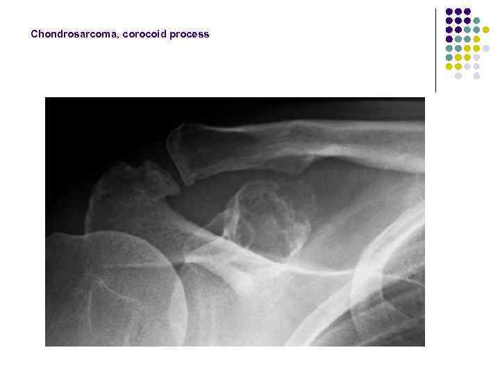 Chondrosarcoma, corocoid process 