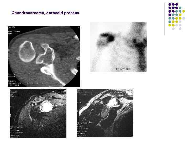 Chondrosarcoma, corocoid process 