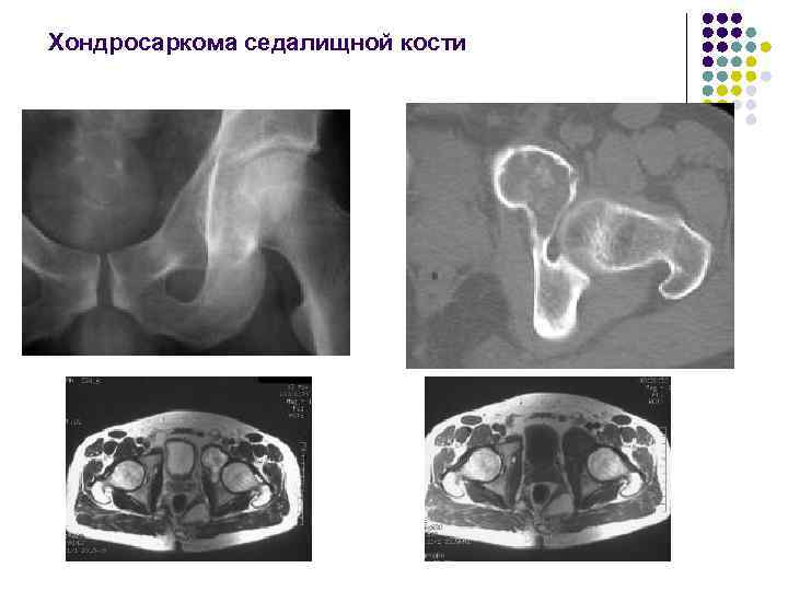 Хондросаркома седалищной кости 