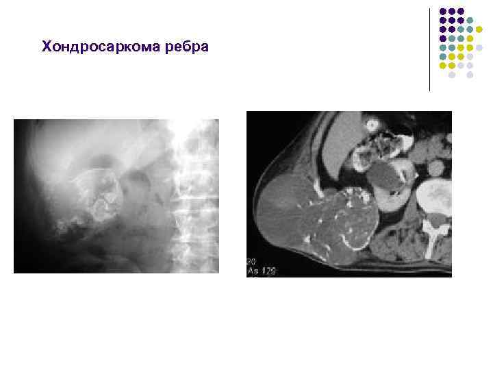 Хондросаркома ребра 