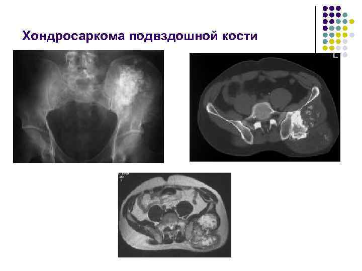 Хондросаркома подвздошной кости 