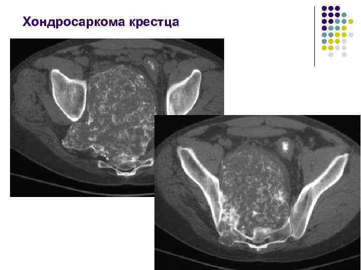 Хондросаркома крестца 