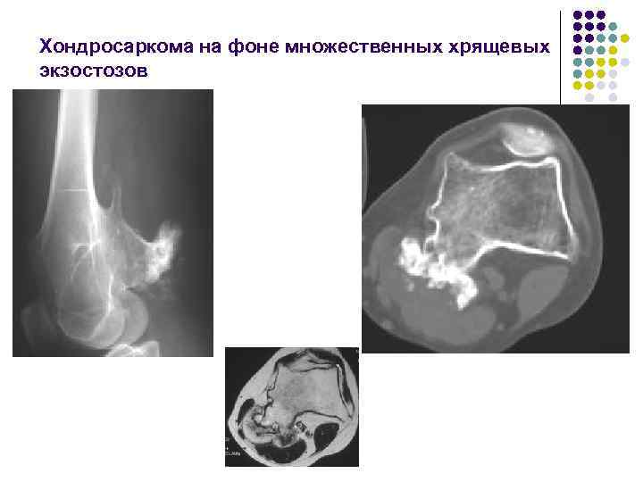 Хондросаркома на фоне множественных хрящевых экзостозов 