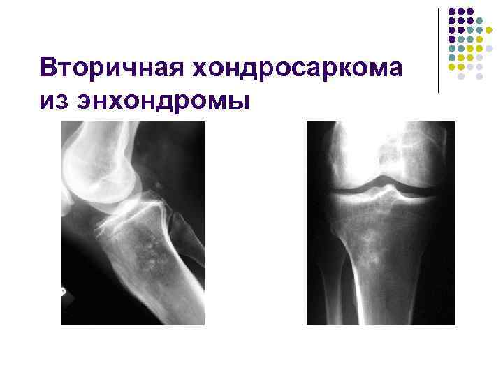 Вторичная хондросаркома из энхондромы 