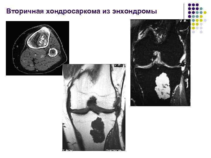 Вторичная хондросаркома из энхондромы 