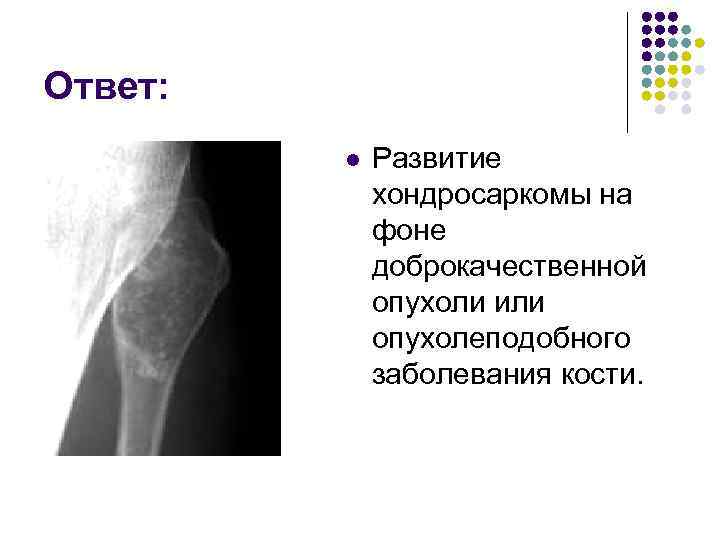 Ответ: l Развитие хондросаркомы на фоне доброкачественной опухоли или опухолеподобного заболевания кости. 