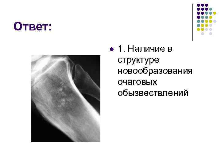 Ответ: l 1. Наличие в структуре новообразования очаговых обызвествлений 