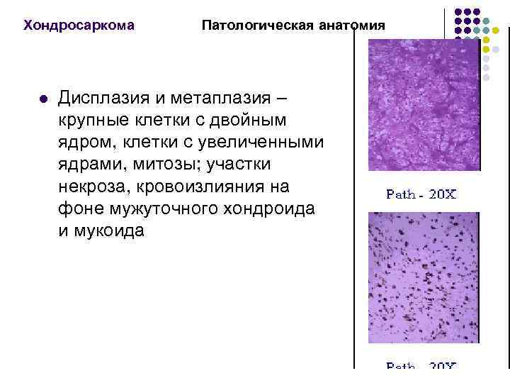 Хондросаркома l Патологическая анатомия Дисплазия и метаплазия – крупные клетки с двойным ядром, клетки