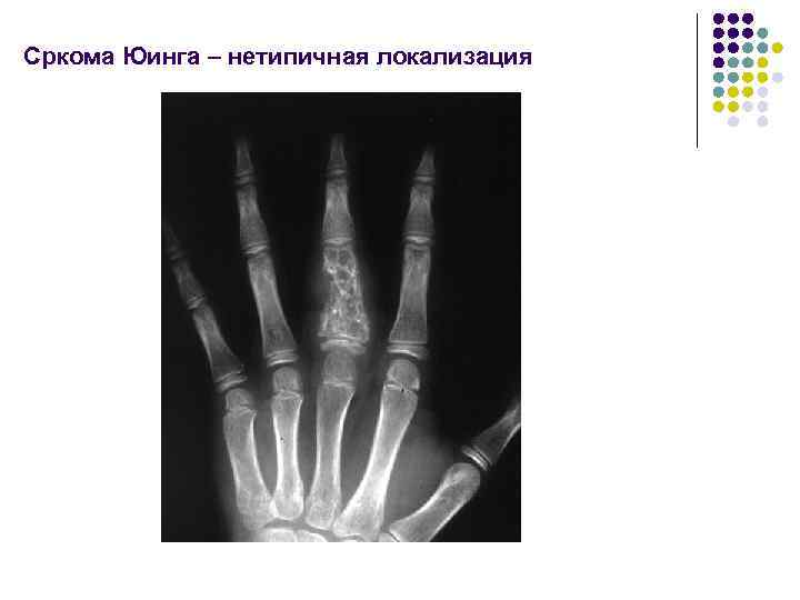 Сркома Юинга – нетипичная локализация 