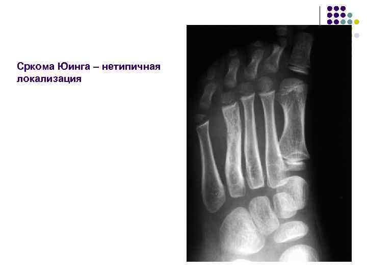 Сркома Юинга – нетипичная локализация 