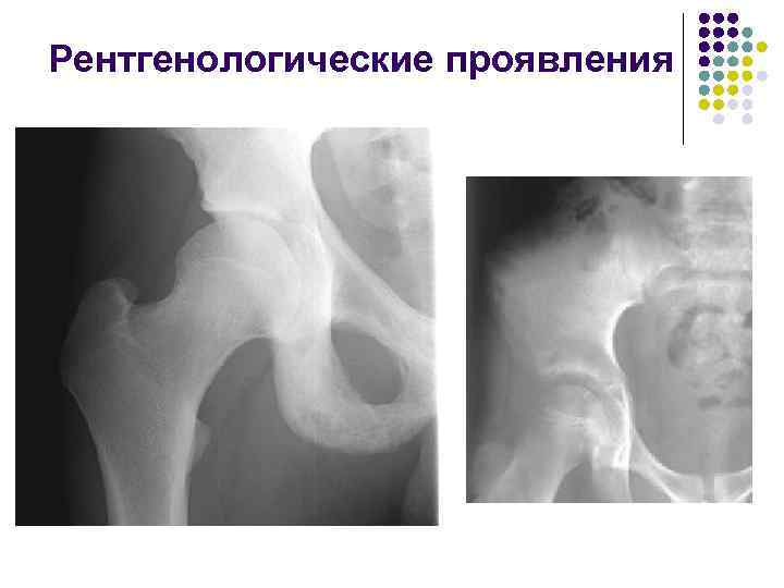Рентгенологические проявления 