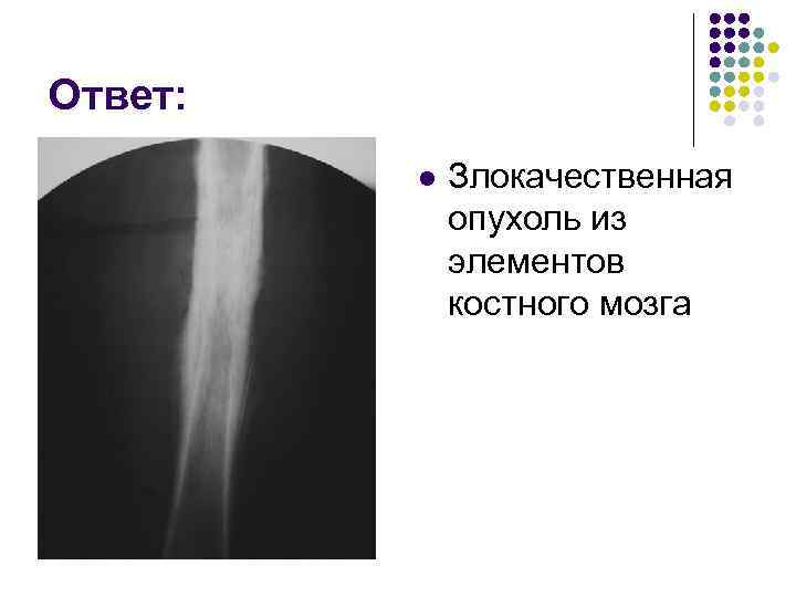 Ответ: l Злокачественная опухоль из элементов костного мозга 