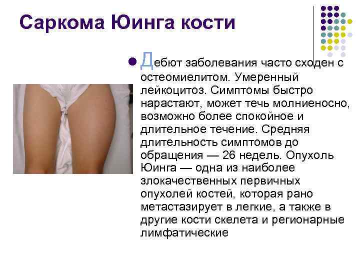 Саркома Юинга кости l Дебют заболевания часто сходен с остеомиелитом. Умеренный лейкоцитоз. Симптомы быстро