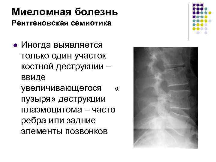 Миеломная болезнь фото больных