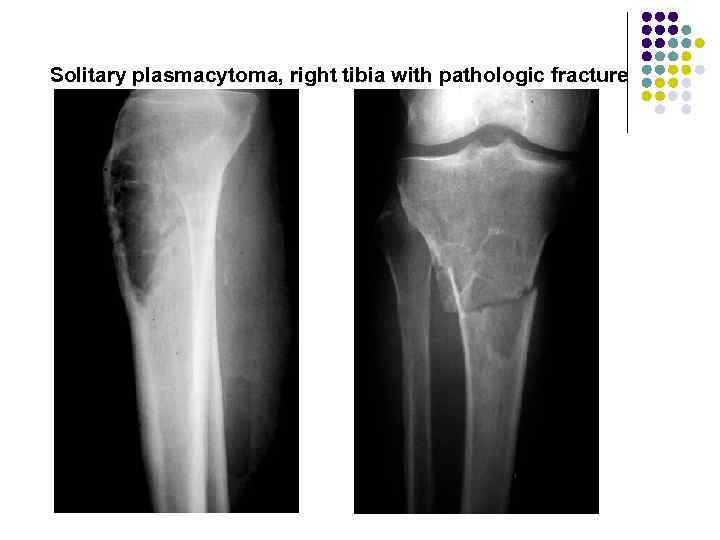 Solitary plasmacytoma, right tibia with pathologic fracture 