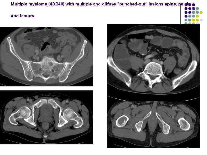 Multiple myeloma (40. 340) with multiple and diffuse "punched-out" lesions spine, pelvis and femurs