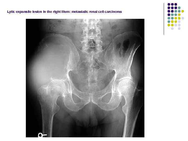 Lytic expansile lesion in the right ilium: metastatic renal cell carcinoma 