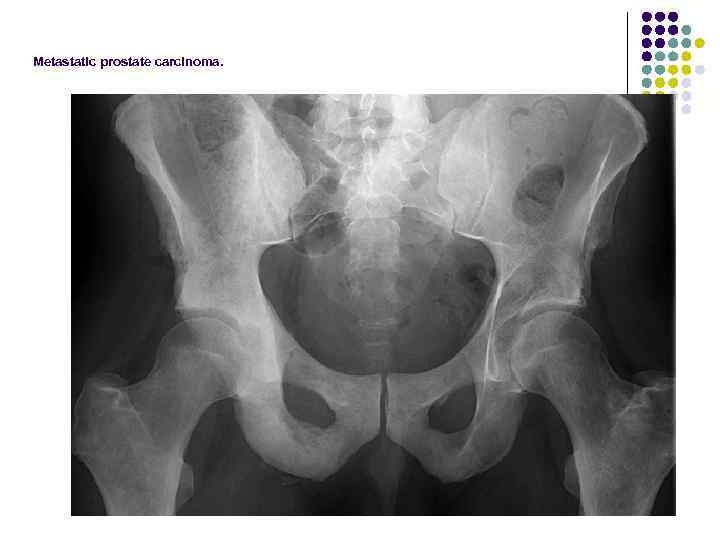 Metastatic prostate carcinoma. 